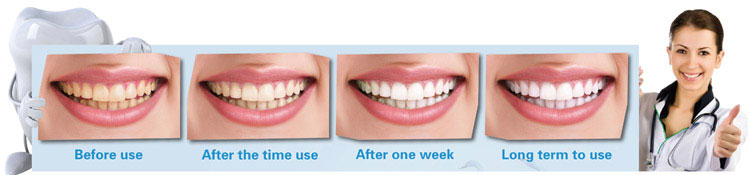 shareusmile Home-Kits-instant-teeth-whitening-perfect-white-teeth-effect