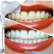 shareusmile SH005E-Teeth Cleaning Kit- Whiten Teeth Quickly Home Dental Whitening Kit