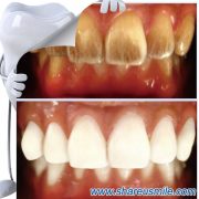 shareusmile SH0712-Teeth Cleaning Kit–Natural Teeth Whitening Options That Work