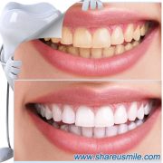 shareusmile SH102-Teeth Cleaning Kit-Regular dental cleanings will lead you to cleaner, healthier teeth