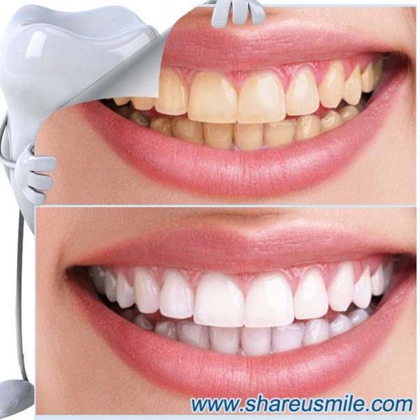 shareusmile SH102-Teeth Cleaning Kit-Regular dental cleanings will lead you to cleaner, healthier teeth