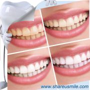 shareusmile SH007-Innovative Teeth Cleaning Kit-Only Water magic smile teeth cleaning kit tooth brush most effective teeth whitening