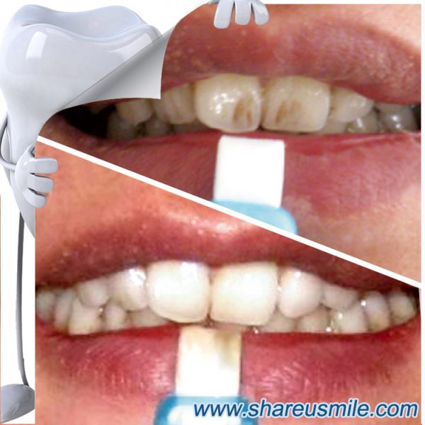 shareusmile SH012-Teeth Cleaning Kit – Instant Teeth Whitening Advanced Kit for good oral hygiene.
