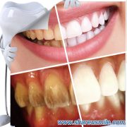 shareusmile Teeth Cleaning Kit-Similar-to-Teeth-Whitening-Pen–at-home-teeth-whitening-