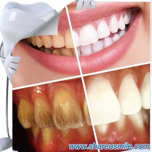 shareusmile Teeth Cleaning Kit-Similar-to-Teeth-Whitening-Pen--at-home-teeth-whitening-