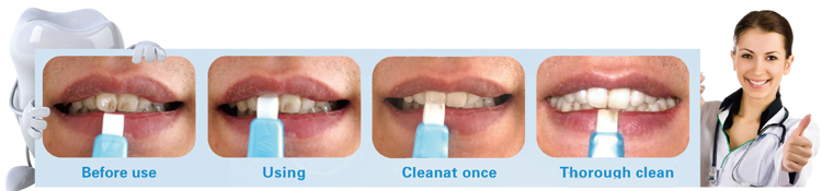 shareusmile effective home teeth whitening kit 